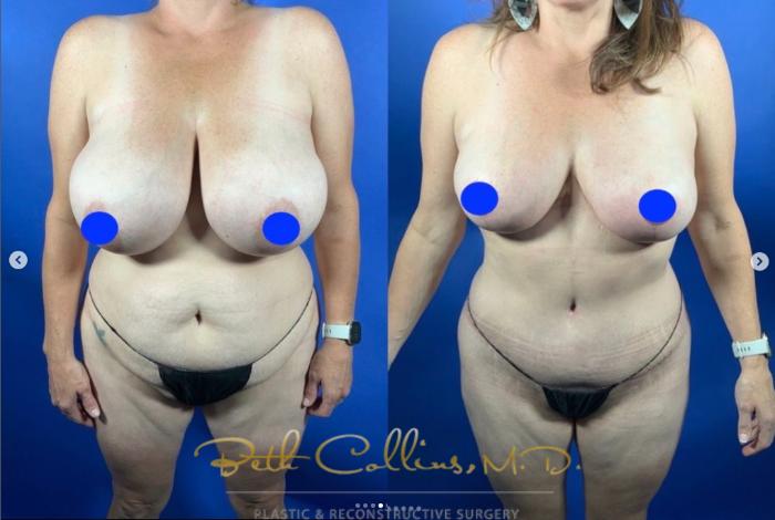 Before & After Tummy Tuck Case 281 Front View in Guilford, CT