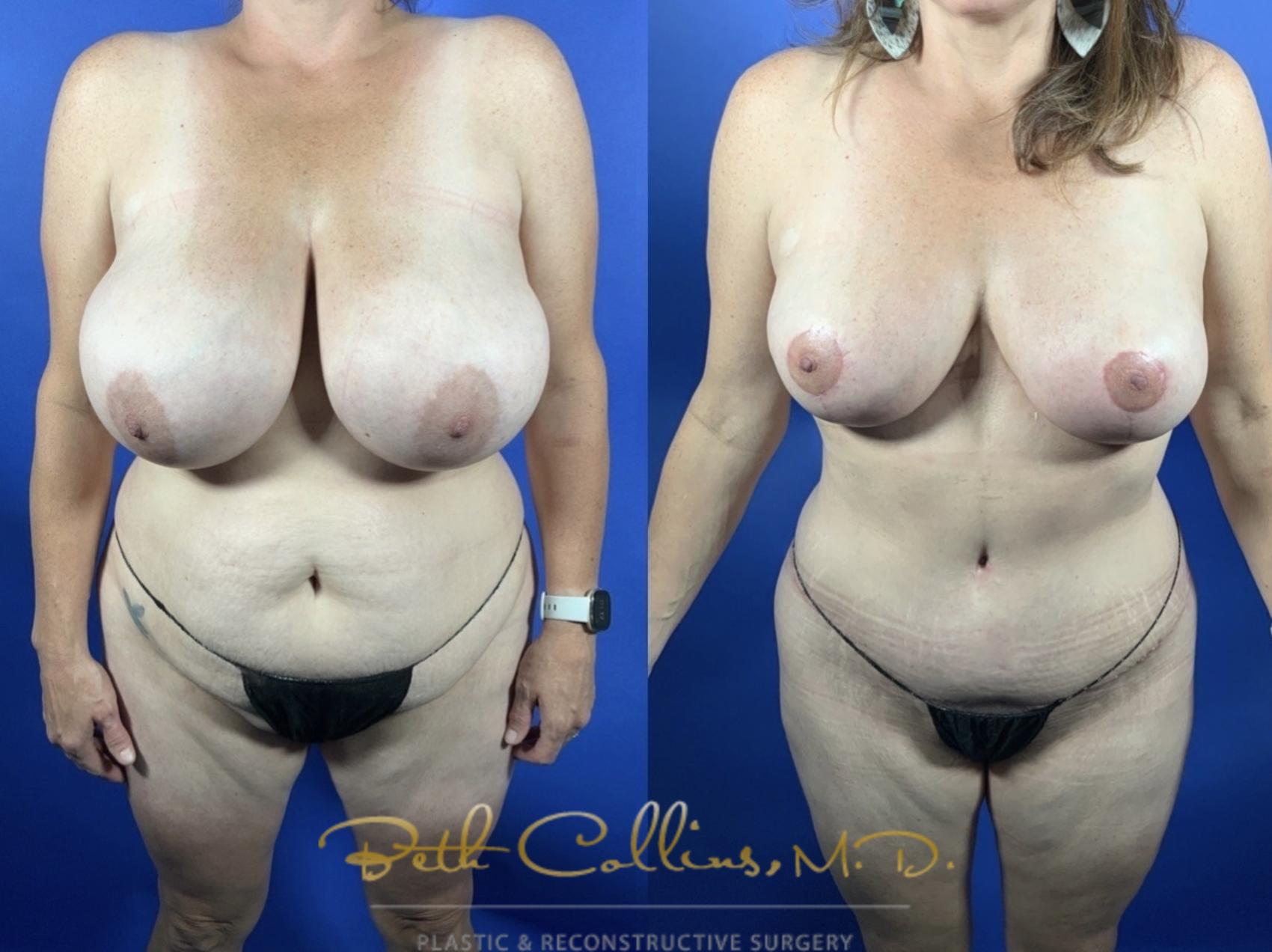 Abdominoplasty with lipo360 and breast reduction
