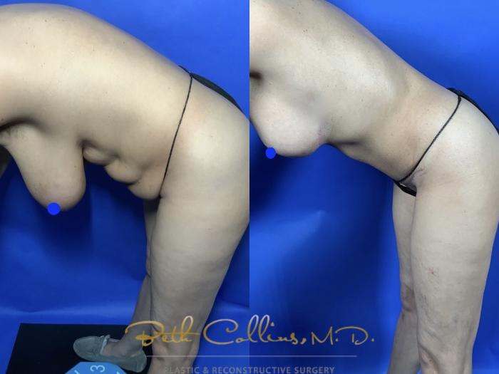 The effects of body contouring are often best demonstrated using dynamic moves, such as diving in to a pool.