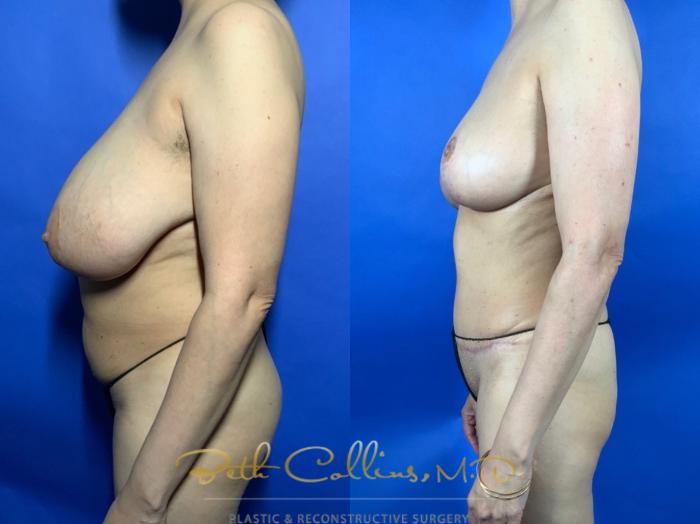 Body Contouring: This petite lady was bothered by her large breasts and excess fat in her abdomen and trunk. She had a bilateral breast reduction and abdominoplasty with 360 degree liposuction. This narrowed her waist, slimmed her back and flattened her abdomen while reducing the size of her breasts and lifting them at the same time.